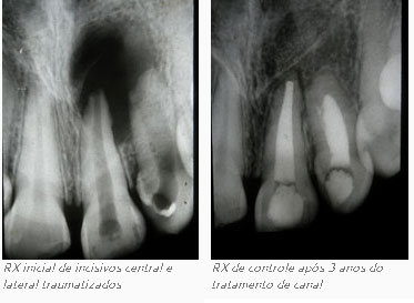 (Fonte: Dental Press Endod. 2012 July-Sept;2(3):67-73)